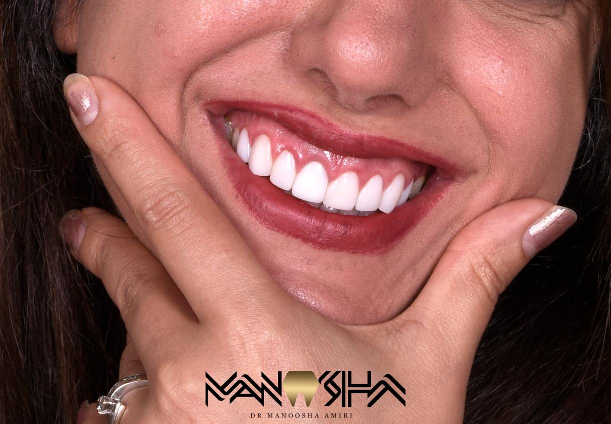 اصلاح شکل و فرم دندان ها 1 image