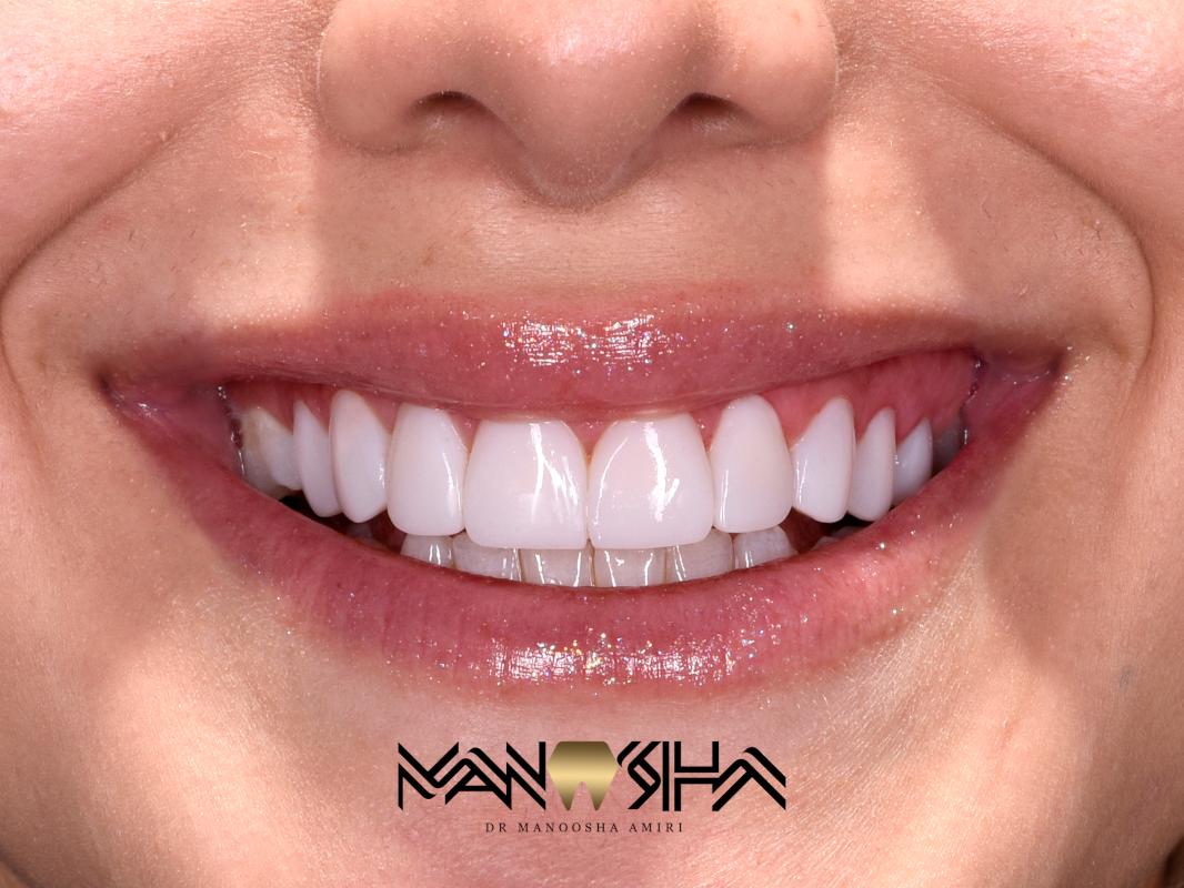 اصلاح شکل و فرم دندان ها 2 image