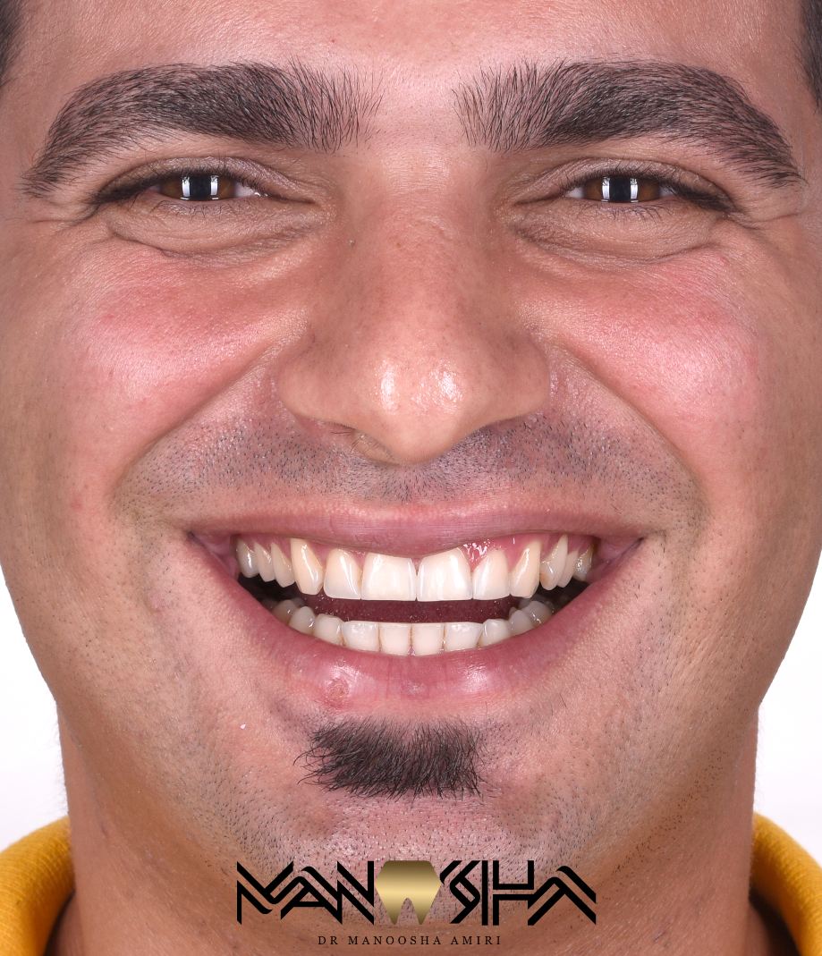 بستن فاصله میان دندان ها 1 image