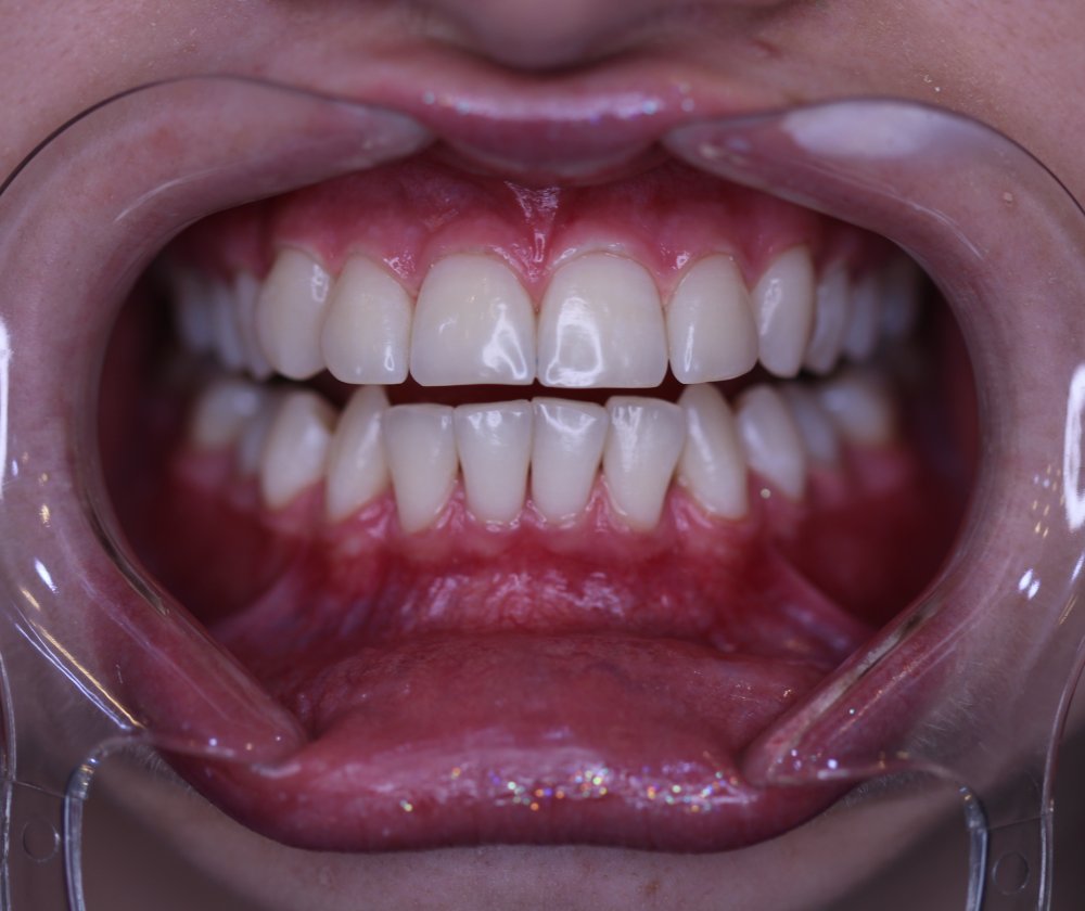 سفید کردن دندان ها 2 image