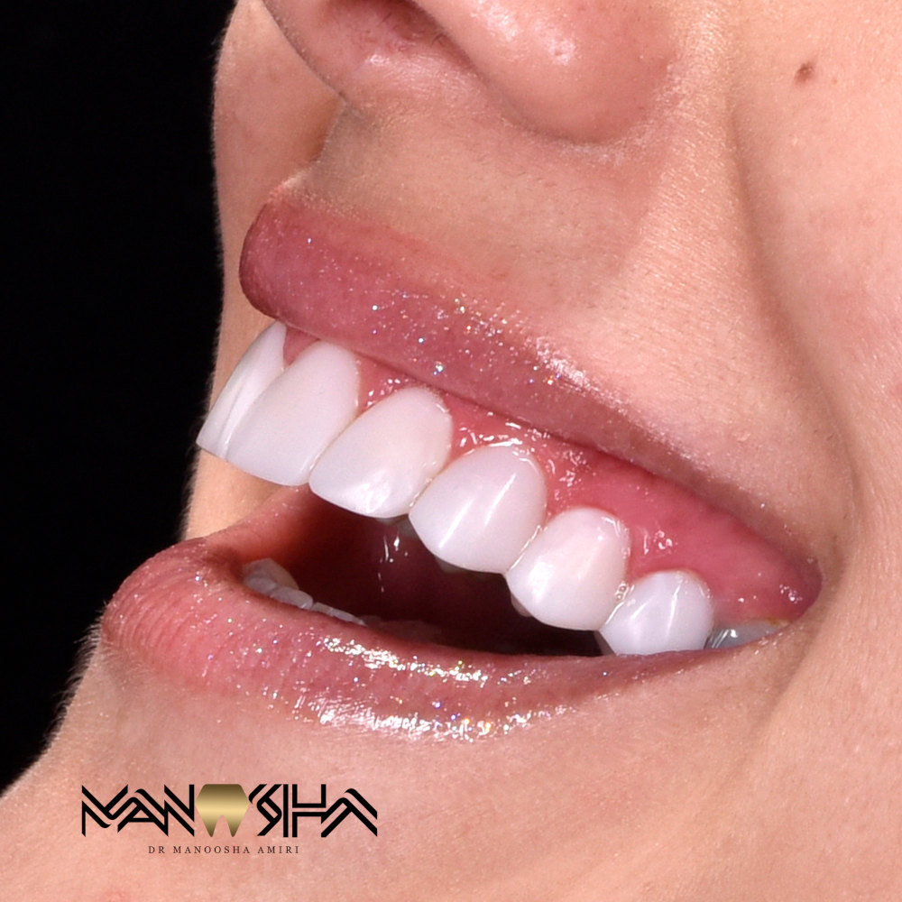 روکش دندان مانوشا امیری