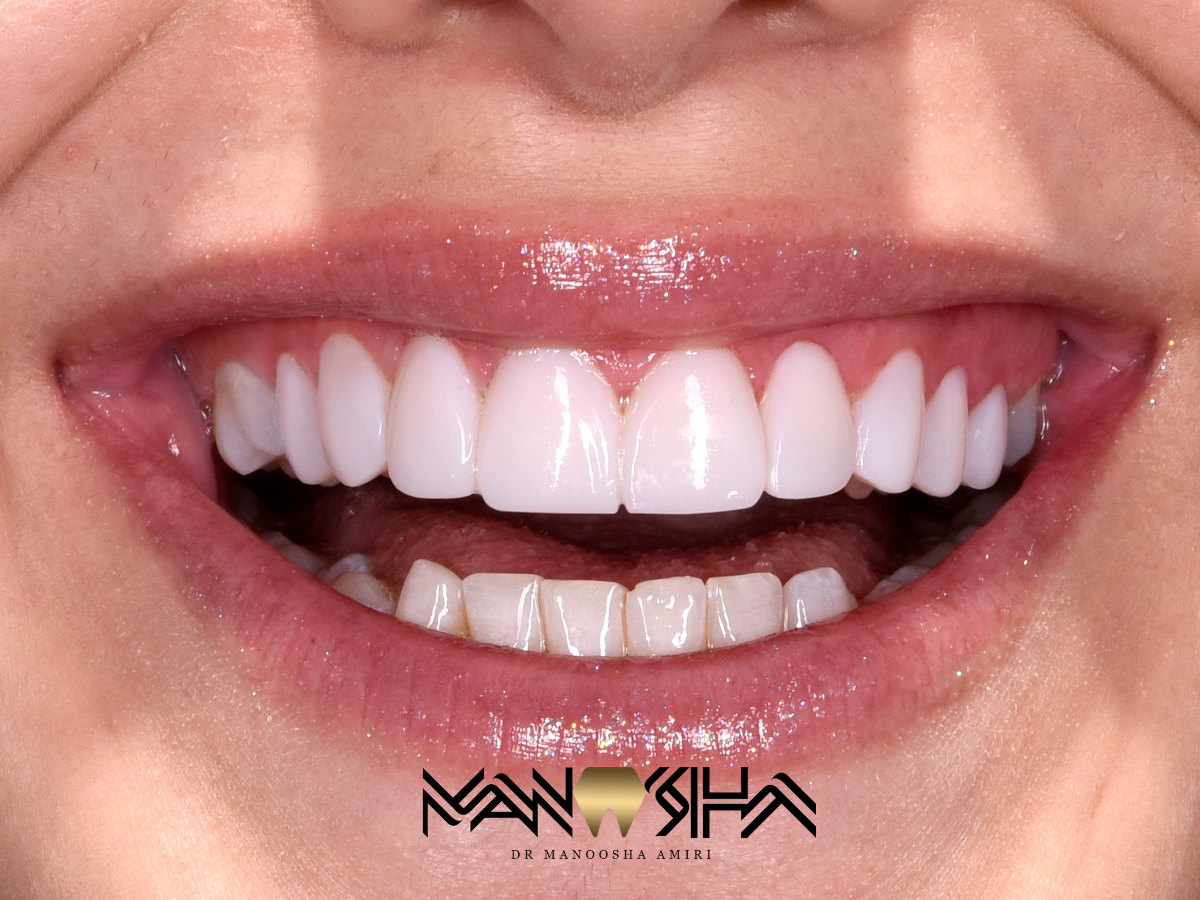 روکش تمام سرامیک