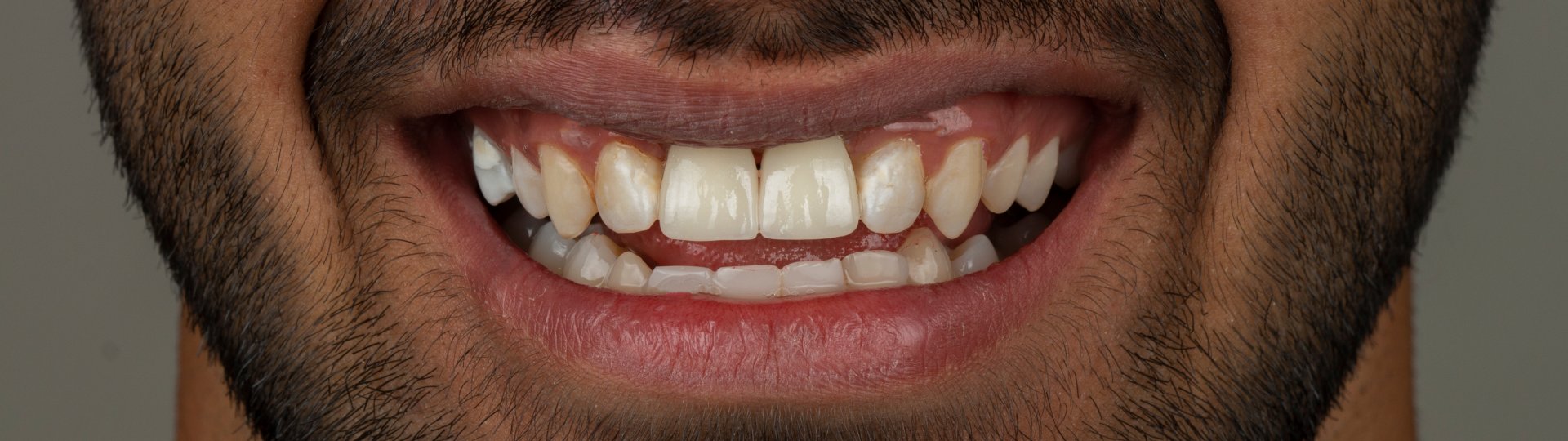 ایمپلنت دندان