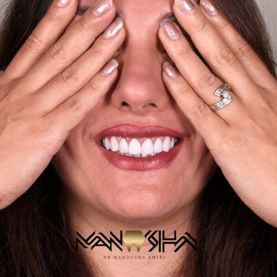 کامپوزیت ونیر رشت