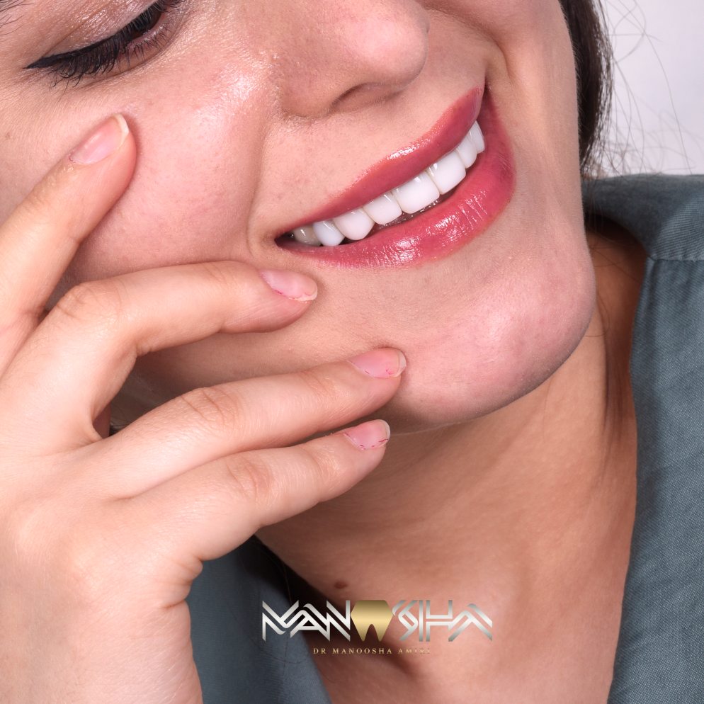 سوالات متداول لمینت دندان