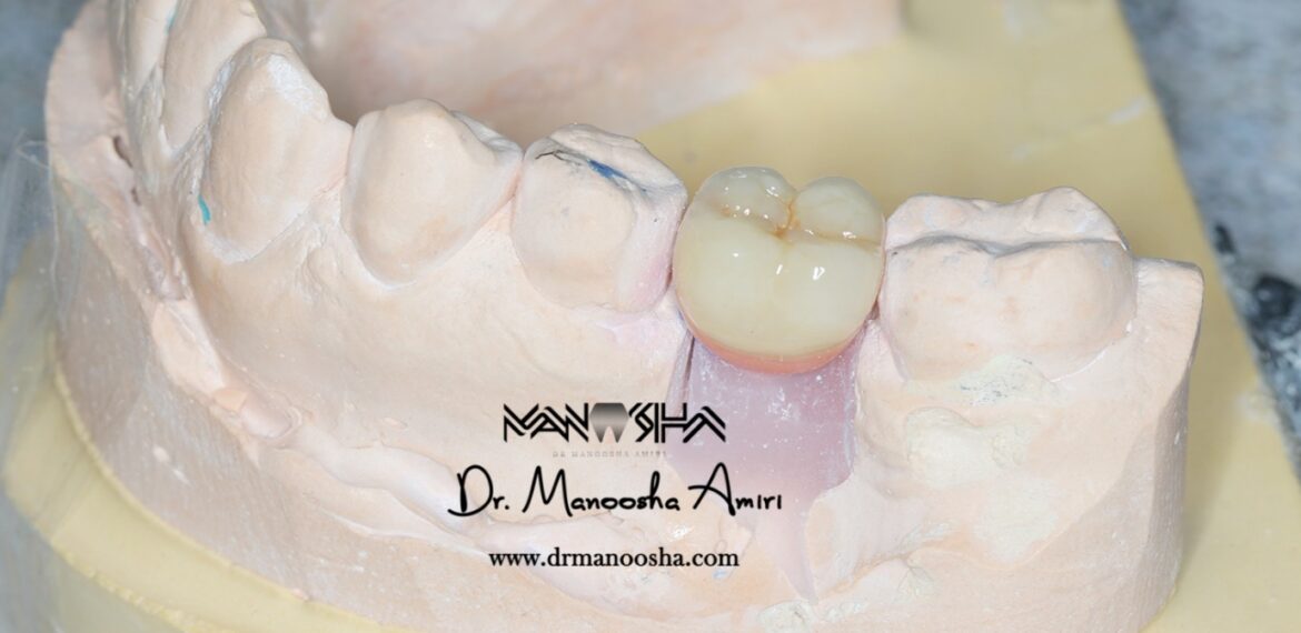 چگونگی حفظ ساختار طبیعی دندان توسط تاج دندان