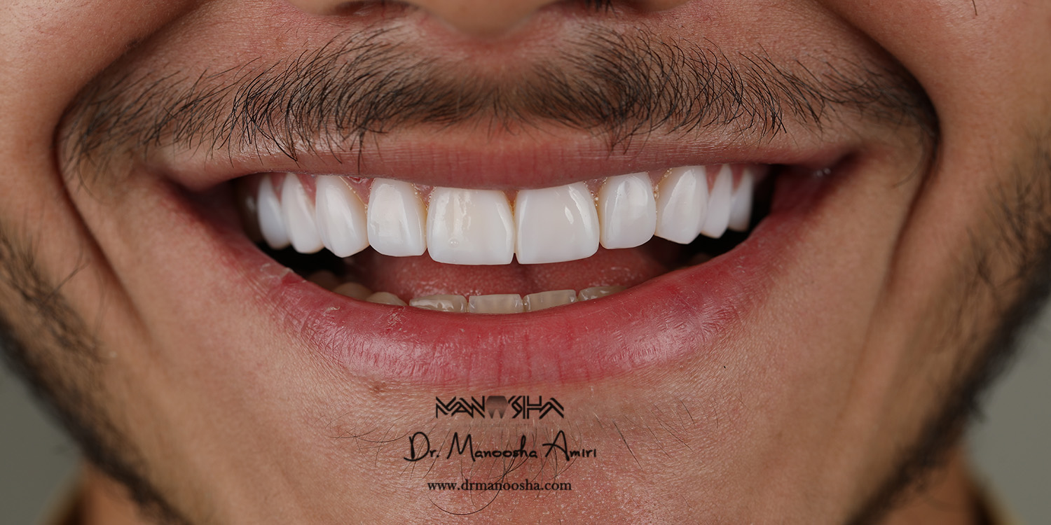 جراحی لثه کامپوزیت لمینت