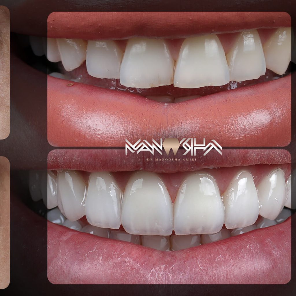 تاثیر کامپوزیت با کیفیت در دندان