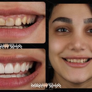قیمت لمینت دندان