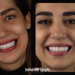 بهترین دکتر کامپوزیت دندان در تهران