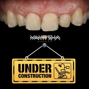 التهاب لثه بعد از کامپوزیت