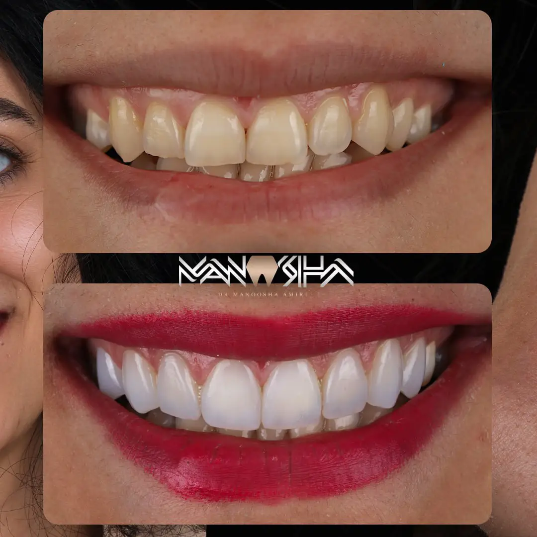 کامپوزیت دندان