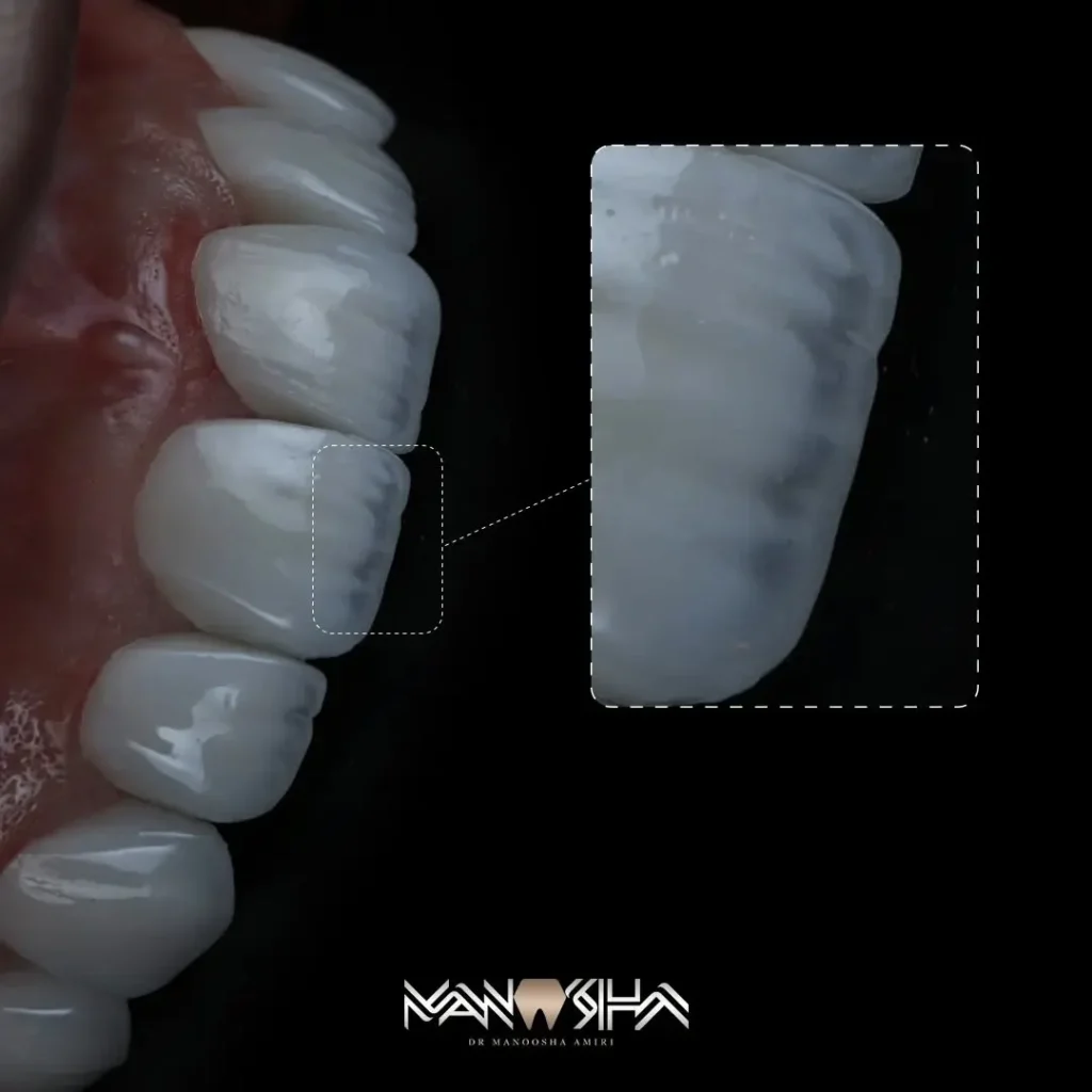 بهترین دکتر لمینت دندان در تهران-دکتر مانوشا امیری 🦷 1 لمینت دندان در تهران-دکتر مانوشا امیری