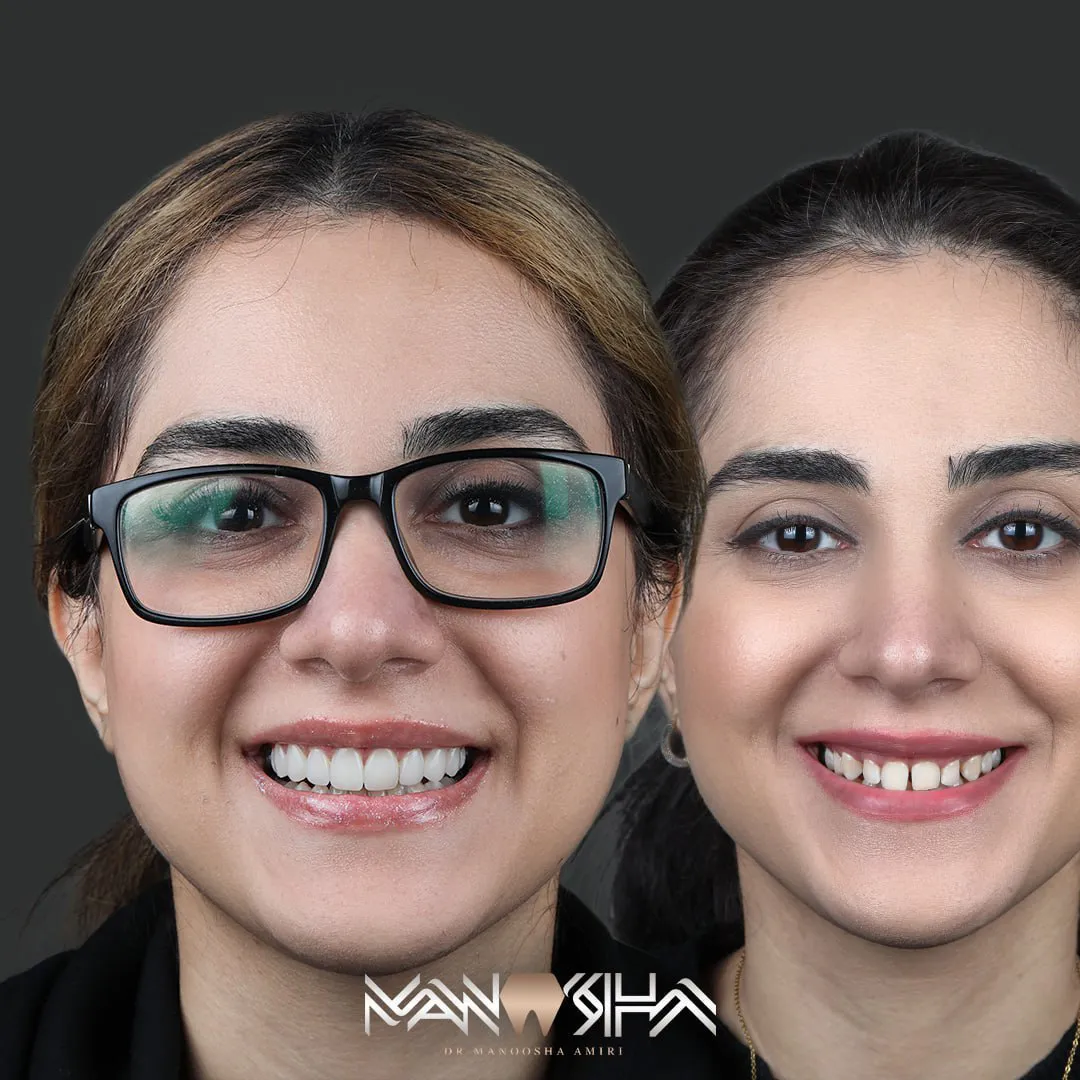 کامپوزیت ونیر در تهران